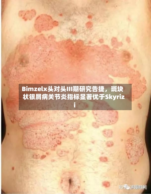 Bimzelx头对头III期研究告捷	，斑块状银屑病关节炎指标显著优于Skyrizi-第2张图片