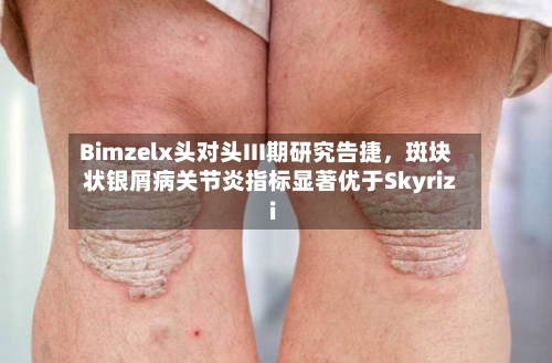Bimzelx头对头III期研究告捷	，斑块状银屑病关节炎指标显著优于Skyrizi-第1张图片