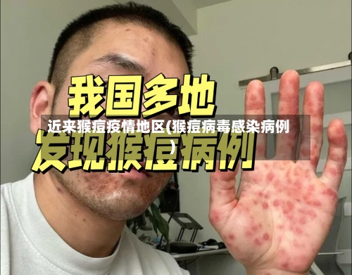 近来猴痘疫情地区(猴痘病毒感染病例)-第3张图片